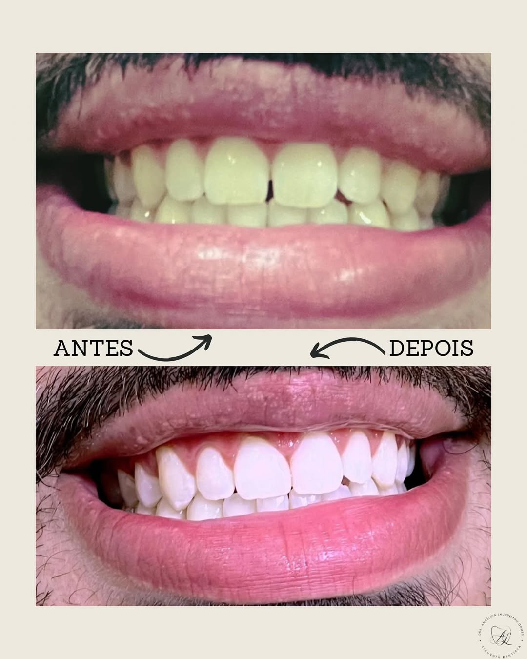 Reconstrução e Brilho (antes e depois)